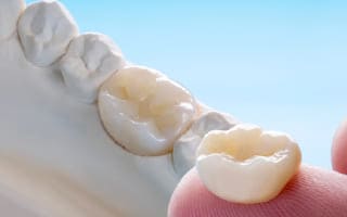Dental Crown in Guadalajara