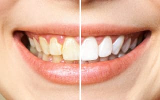 Dentist procedures in Guadalajara México